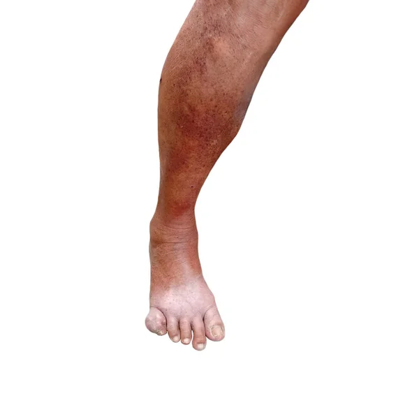 Erysipelas Бактеріальна Інфекція Під Шкірою Ноги Подагри Літні Люди Білому — стокове фото