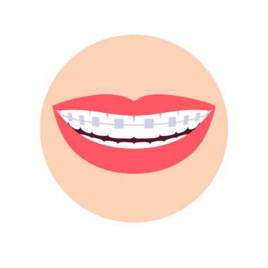 Diş tellerinde ortodonti.