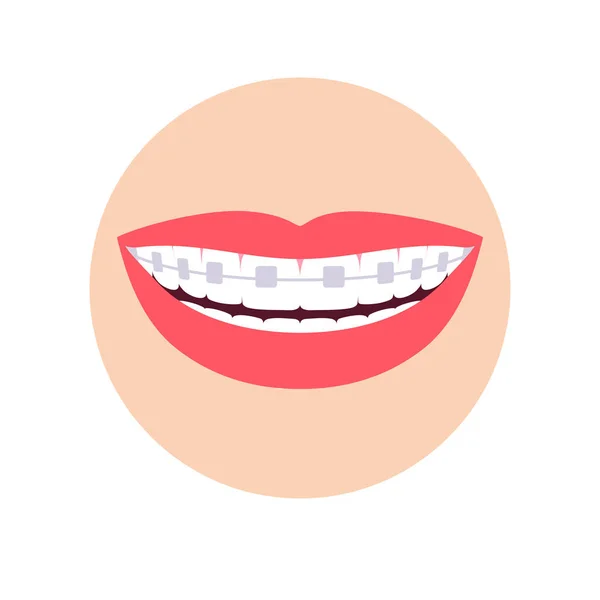 Diş tellerinde ortodonti. — Stok Vektör