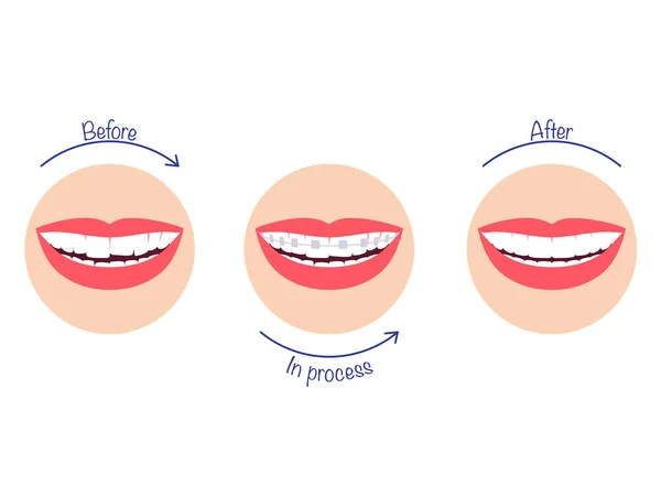 使用牙托矫正牙齿的过程 在之前和之后 矢量说明 — 图库矢量图片