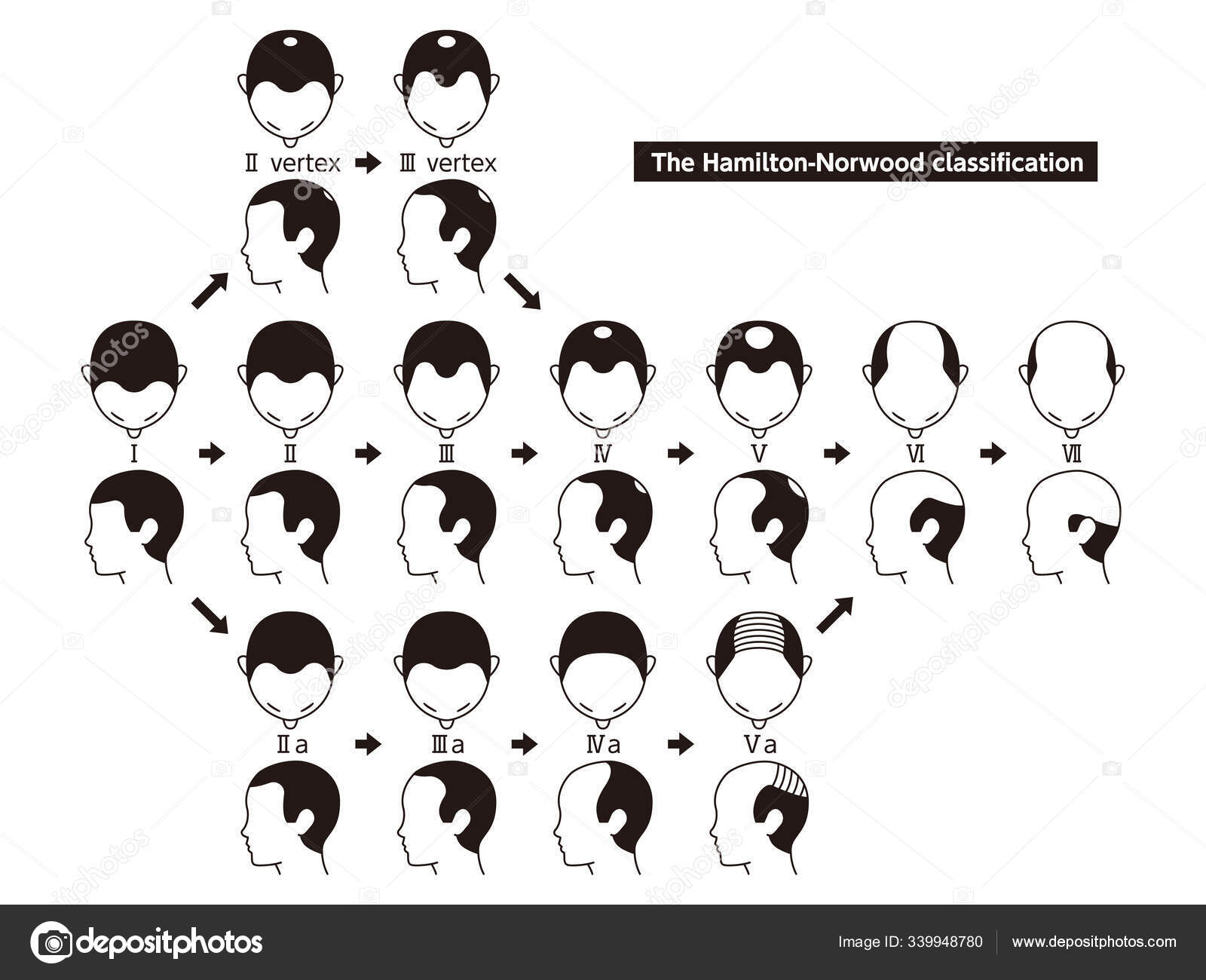 Information chart of hair loss stages and types of baldness illu Stock  Vector Image by ©ankomando #339948780
