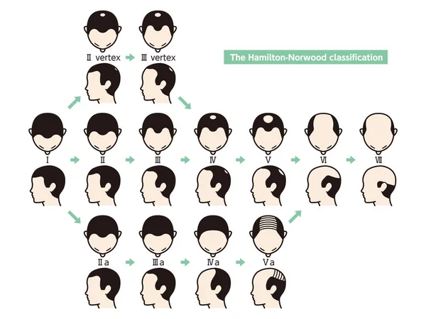 Информационная карта стадий выпадения волос и типов облысения illu — стоковый вектор