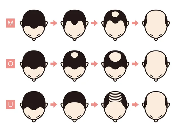 Information chart of hair loss stages and types of baldness illu — 스톡 벡터