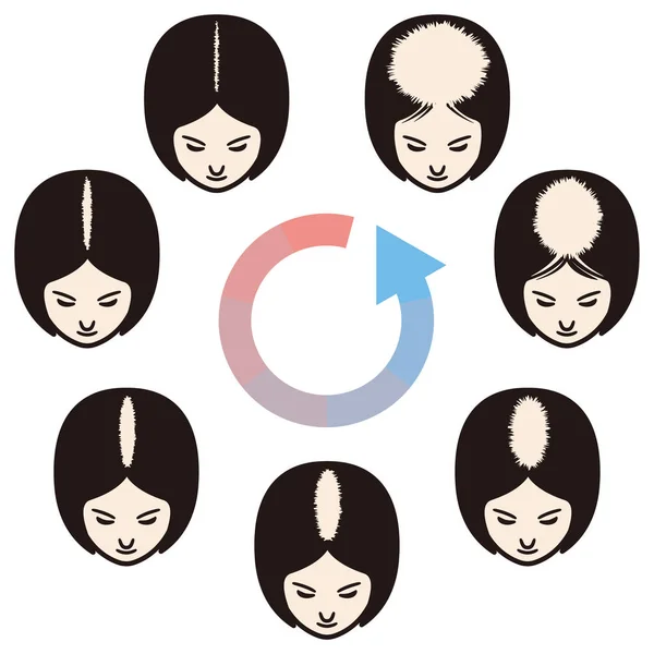 Patrón femenino conjunto de pérdida de cabello. Etapas de la calvicie en las mujeres . — Vector de stock