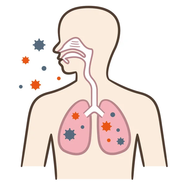 Zakażenie Płuc Zapalenie Płuc Ilustracja Wektora Medycznego Białym Tle — Wektor stockowy