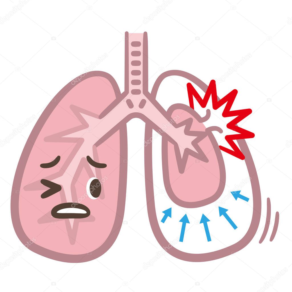 symptoms of pneumothorax lung vector