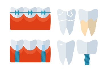 Diş Hekimi Diş implantları ve stomatology ekipman vektör çizim.