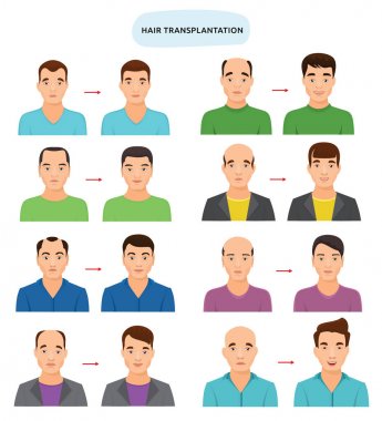 Saç nakli vektör kıllı ekimi hairloss ve kellik kılsız erkek karakter ve saçlı beyaz arka plan üzerinde izole haircat kişiyle kel adam resimde kümesi için sonra
