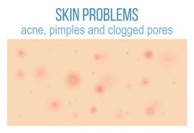 Sorun deri Üstten Görünüm