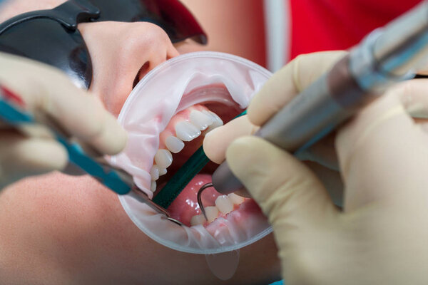 Крупный план стоматолога с помощью специального оборудования отбеливает зубы молодой женщины в черных очках с держателем зуба до идеально белого цвета
