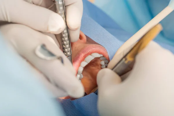 Ludzie, medycyna, koncepcja implantologii i stomatologii - zbliżenie twarzy pacjenta o leczenie zębów w klinice stomatologicznej — Zdjęcie stockowe