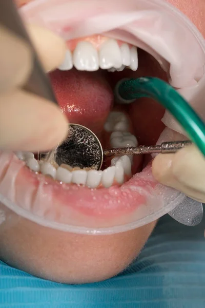 Pacjent z ochrony okulary z zwijacza jamy ustnej podczas leczenia w gabinecie stomatologicznym z Ślinociąg i lusterko dentystyczne i ortodontyczne — Zdjęcie stockowe
