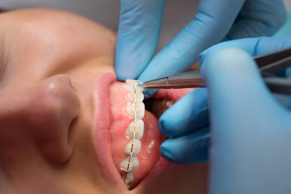 Dentysta sprawdzanie wspornik o nawiasy klamrowe na pacjentki. Szczelnie-do góry. Prawdziwi ludzie. — Zdjęcie stockowe