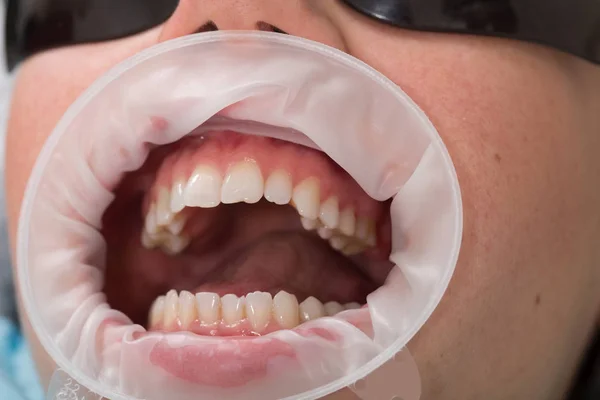 Otwórz usta przez optragate. Biuro dentystyczne — Zdjęcie stockowe
