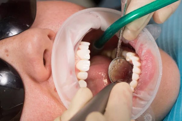 Dziewczyna pacjenta z ochrony okulary z aparatów na zęby i zwijacz jamy ustnej podczas leczenia w gabinecie stomatologicznym z dentystą i asystent z Ślinociąg i dentysta lusterko dentystyczne narzędzia widok z boku — Zdjęcie stockowe