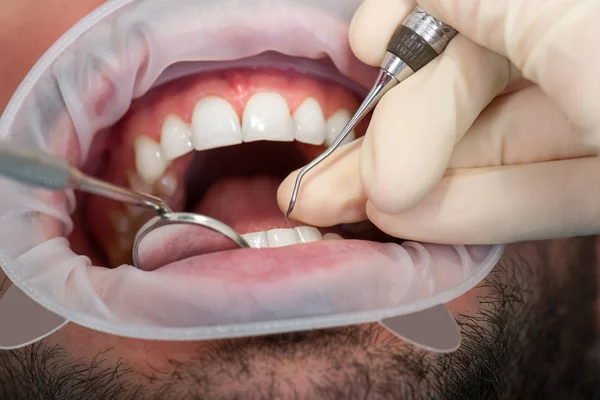 Ekstremalnych bliska młodego człowieka do wybielania zębów u dentysty. Otwarte usta człowieka Wyświetlono zęby z siekierą i usta lustro. — Zdjęcie stockowe