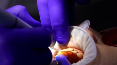 Dentist is making professional dental cleaning in the open mouth