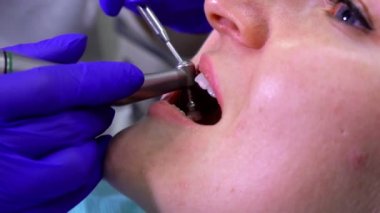 Close up of a dentist making professional dental cleaning in the open mouth
