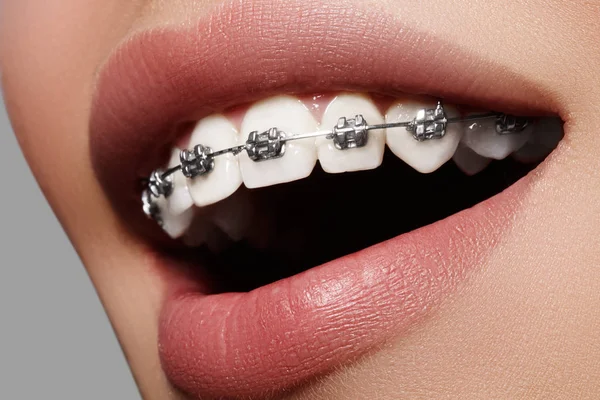 Prachtige macro shot van witte tanden met beugels. Tandartsfoto. Schoonheidsvrouw glimlach met ortodontische accessoires. Orthodontie behandeling. Close-up van gezonde vrouwelijke mond — Stockfoto