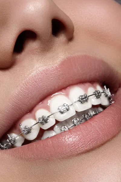 Hermoso macroplano de dientes blancos con aparatos ortopédicos. Foto de cuidado dental. Mujer belleza sonrisa con accesorios de ortodoncia. Tratamiento de ortodoncia. Primer plano de la boca femenina saludable —  Fotos de Stock