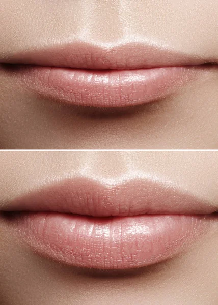 Before and after lips filler injections. Beauty plastic. Beautiful perfect lips with natural makeup. Sexy macro with female mouth.Plump lips augmentation. Salon procedure — Stock Photo, Image