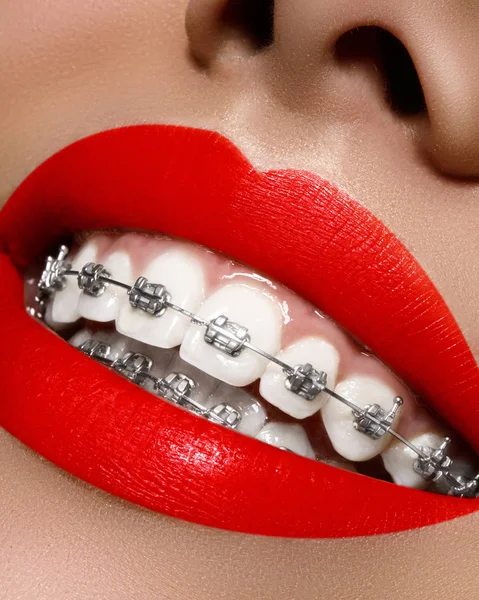 Denti bianchi con l'apparecchio. Foto di cura dentale. Sorriso donna con accessori ortodontici, labbra luminose. Trattamento ortodontico — Foto Stock