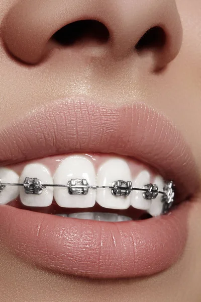 Vackra vita tänder med tandställning. Tandvård foto. Kvinnan leende med ortodontic tillbehör. Ortodonti behandling — Stockfoto