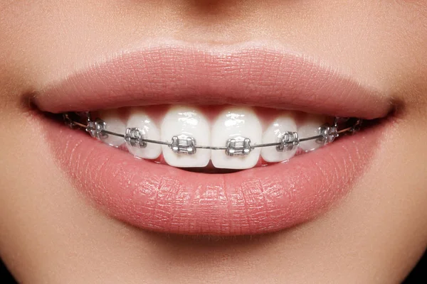 중괄호와 아름 다운 하얀 치아입니다. 치과 치료 사진입니다. Ortodontic 액세서리 여자의 미소입니다. 치열 교정 치료 — 스톡 사진