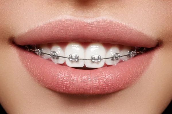 Hermosos dientes blancos con tirantes. Foto de cuidado dental. Mujer Sonrisa con Accesorios Ortodónticos. Ortodoncia Tratamiento —  Fotos de Stock