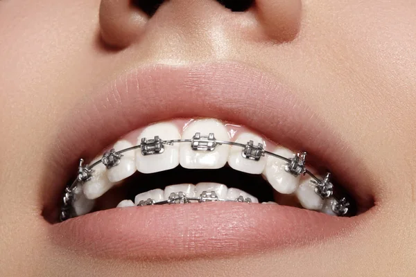 Beautiful white teeth with braces. Dental care photo. Woman smile with ortodontic accessories. Orthodontics treatment