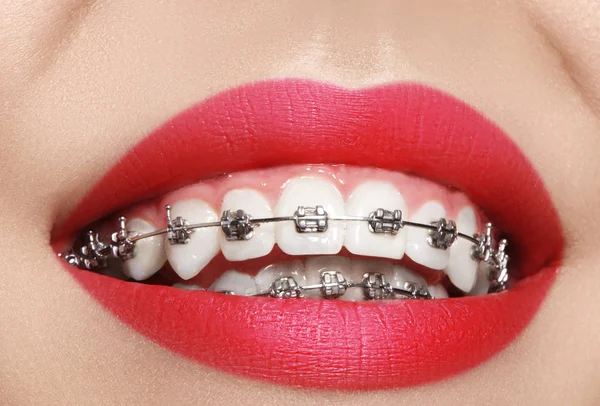 Hermoso macroplano de dientes blancos con aparatos ortopédicos. Foto de cuidado dental. Belleza mujer sonrisa con accesorios de ortodoncia — Foto de Stock