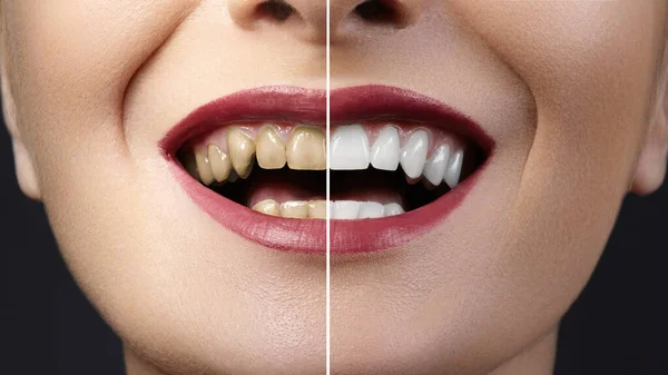 Foto Primo Piano Prima Dopo Trattamento Sbiancamento Procedura Impiallacciatura Dentale — Foto Stock