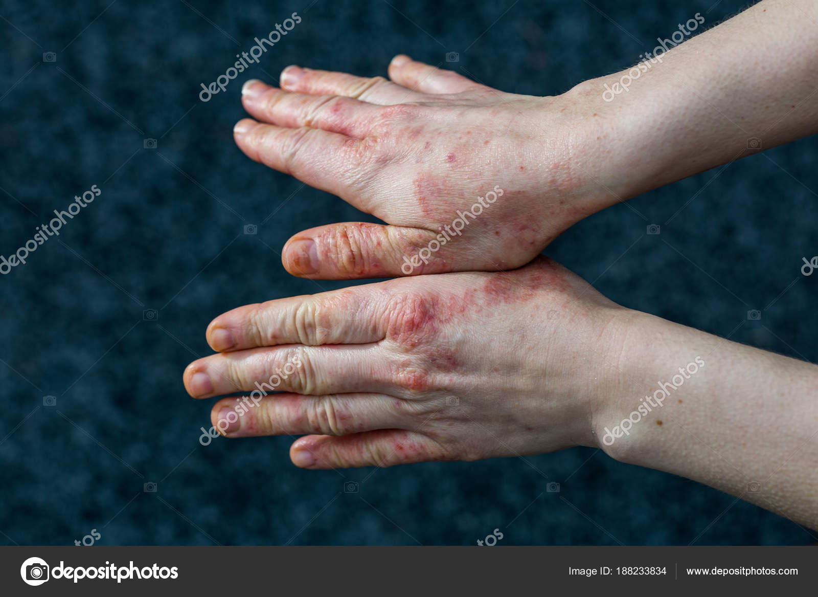 Photos Dyshidrosis Hands With Dry And Stressed Red Dyshidrotic Eczema Skin From Cleaning Stock Photo C Oscity 134