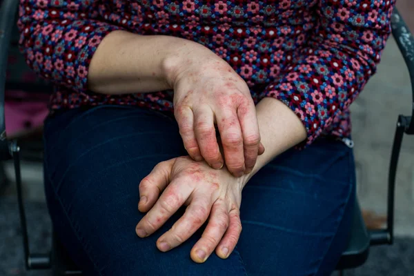 Ung kvinna med torr och stressad röd dyshidrotic eksem händer på grund av rengöring med starka rengöringsmedel — Stockfoto