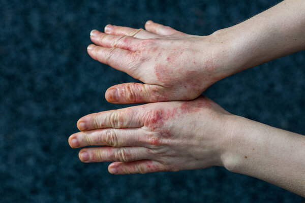 Hands with dry and stressed red dyshidrotic eczema skin from cleaning 