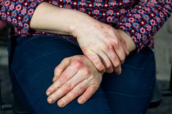 Sjuka händer med torr och stressad röd dyshidrotic eksem hud — Stockfoto