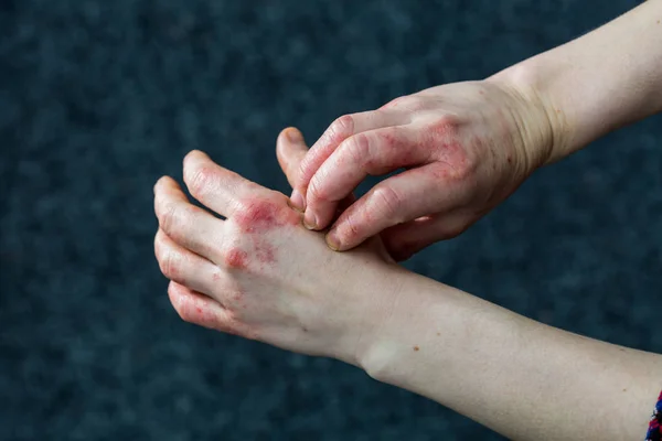 Руки с сухой и напряженной красной дишидротической экземой — стоковое фото