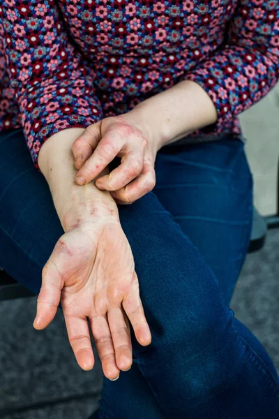 Ung kvinna med torr och stressad röd dyshidrotic eksem omfattas händer — Stockfoto