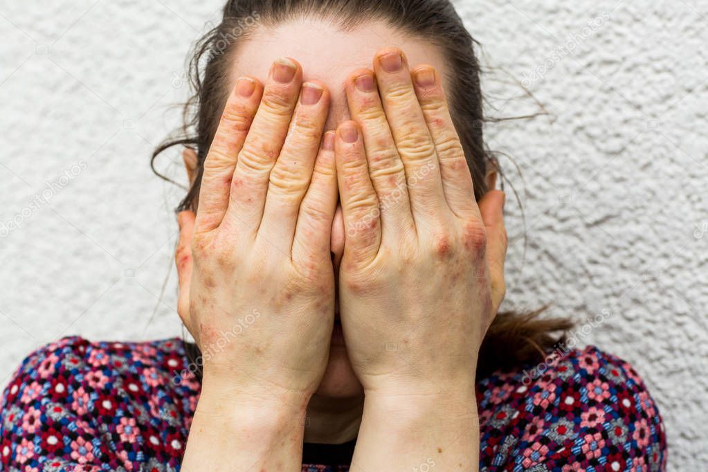 Young woman with dry and stressed red dyshidrotic eczema hands in front her face