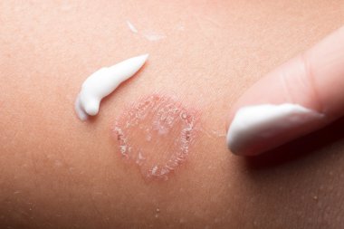 Yüzük solucanı enfeksiyonu, deride dermatofizoz.