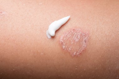 Yüzük solucanı enfeksiyonu, deride dermatofizoz.
