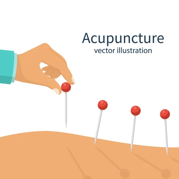 Acupuncture treatment closeup — Stock Vector