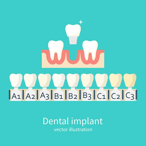 Schattierungen des Implantatvektors — Stockvektor