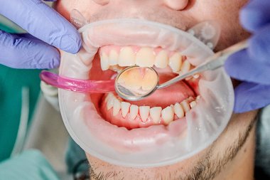 Diş hekiminin randevusunda tükürük pompasıyla diş gösterimi.