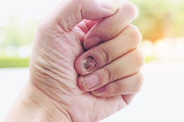 Tırnak mantar enfeksiyonu ve insan eli zarar. Onikomikoz parmakla