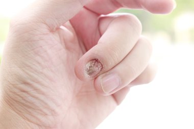 Tırnak mantar enfeksiyonu ve insan eli zarar. Onikomikoz parmakla