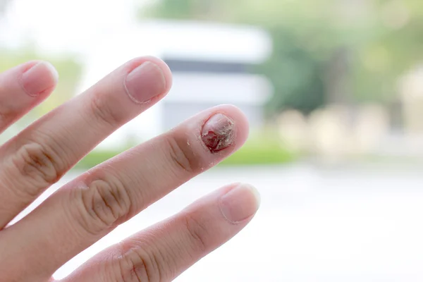 Infection fongique des ongles et dommages sur la main humaine. Doigt avec onychomycose — Photo