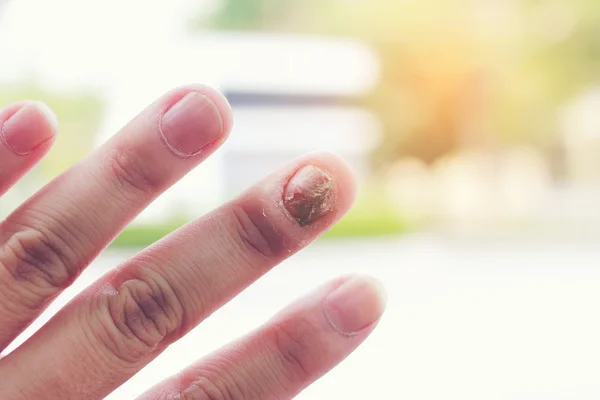 Fungal nail infection and damage on human hand. Finger with onychomycosis — Stock Photo, Image