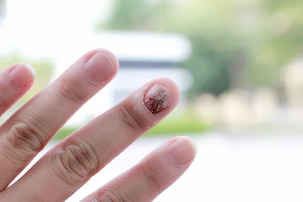 Infekce mykotických nehtů a škody na lidské ruce. Prst se Onychomykóza — Stock fotografie