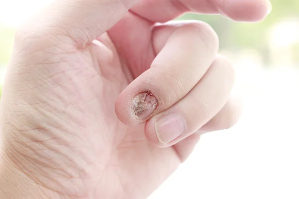 Infekce mykotických nehtů a škody na lidské ruce. Prst se Onychomykóza — Stock fotografie